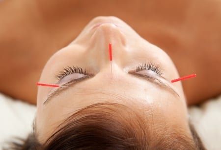 acupuncture treatments